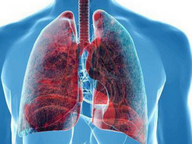 80% người Việt mắc ung thư phổi vì những thói quen ”tệ hại” này