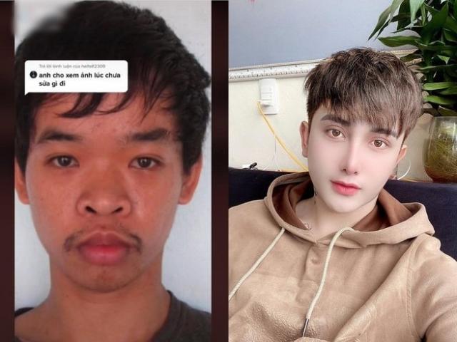 Chàng trai Việt lên báo nước ngoài vì sau phẫu thuật thẩm mỹ quá đẹp trai