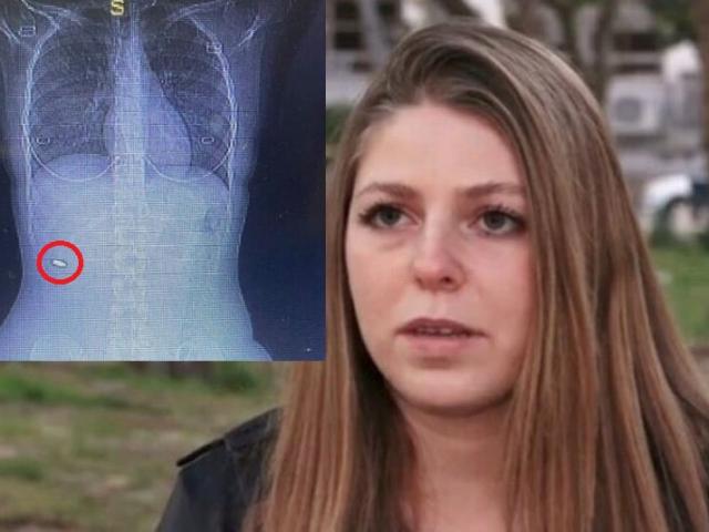 Israel: Cô gái đến dự đám cưới bạn, 3 tháng sau phát hiện vật kinh khủng trong cơ thể