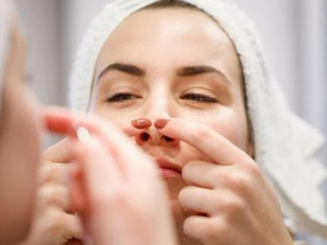 'Bản đồ' mụn trên khuôn mặt làm rõ nguyên nhân gây mụn