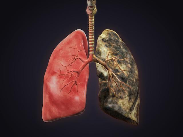 Trắc nghiệm: Những điều ai cũng cần biết về ung thư phổi trước khi quá muộn