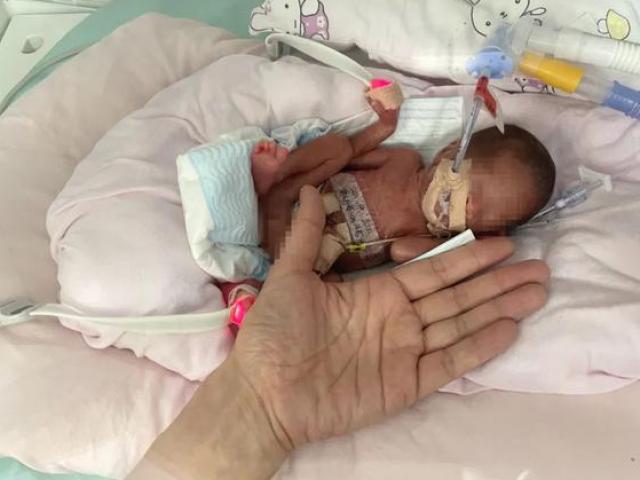 Kỳ tích sống sót của em bé sinh non nặng vỏn vẹn 450 gam, bé như bàn tay