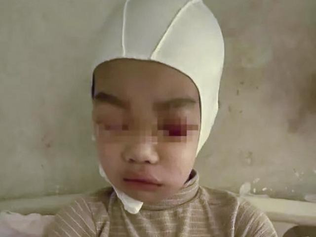 Nói chuyện trong lớp, nam sinh Trung Quốc bị thầy giáo giật tóc tới chấn thương sọ não