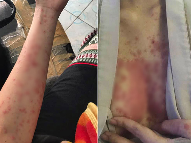 Liên tục thức khuya tới 3h sáng, người phụ nữ bị phát ban khủng khiếp