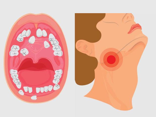 Có những dấu hiệu này, khám ngay ung thư miệng kẻo ”hối không kịp”