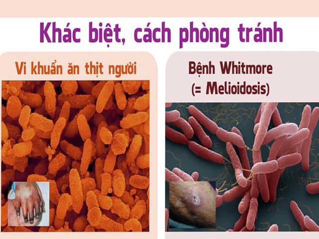 Phân biệt bệnh do ‘vi khuẩn ăn thịt người’ và bệnh whitmore