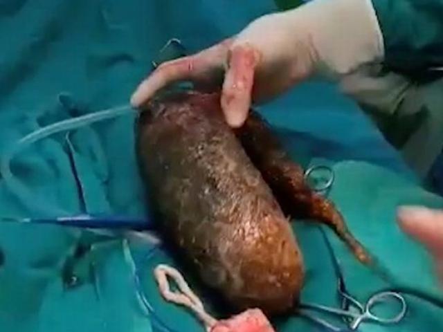 Phẫu thuật cắt bỏ khối u, không ngờ tìm thấy khối tóc khổng lồ nặng 7kg