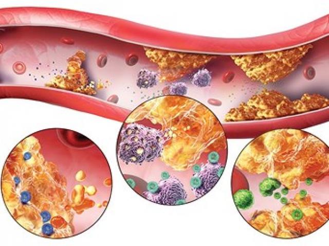 Hai sát thủ của tim mạch và cách ăn uống đúng để đẩy lùi căn bệnh này