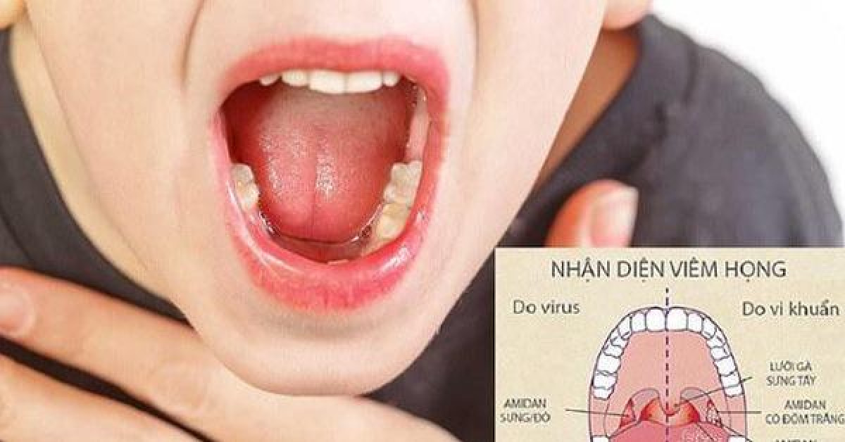 Giao mùa, nếu bố mẹ có thói quen này, con dễ mắc viêm họng và nhiều bệnh nguy hiểm khác