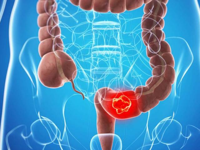 Quá yêu món thịt nướng, người đàn ông mắc ung thư đại trực tràng