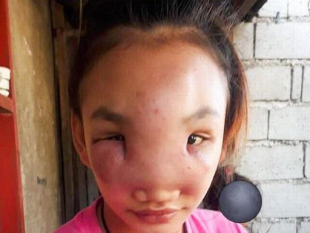 Nặn mụn trên mũi, cô gái 17 tuổi bất ngờ mắc bệnh lạ suốt 1 năm chưa khỏi