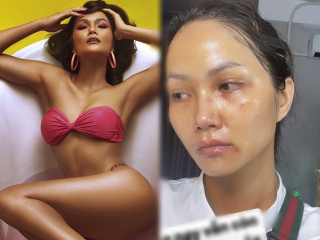 Hoa hậu H'Hen Niê lộ ảnh mặt mộc thâm tím, thực hư thế nào?