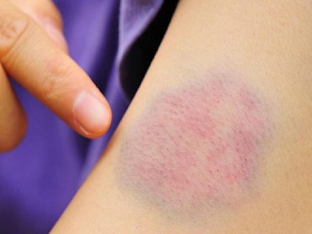 Cẩn trọng với những vết bầm tím trên da, rất có thể bạn đang mắc bệnh cực nguy hiểm